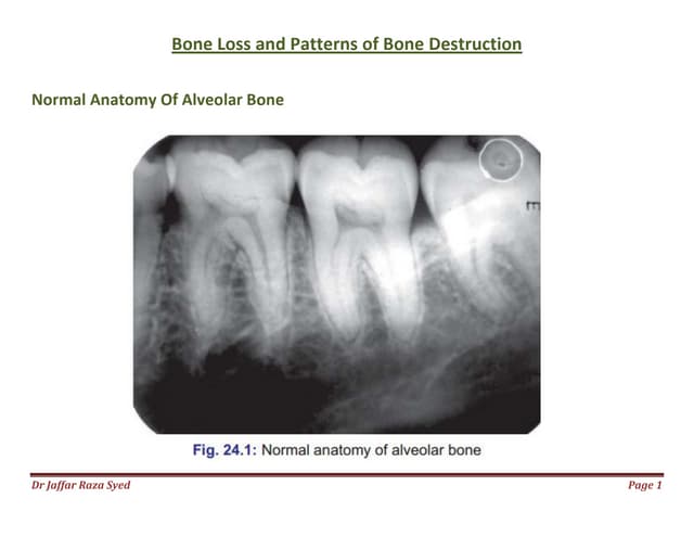 024.bone loss and patterns of bone ...
