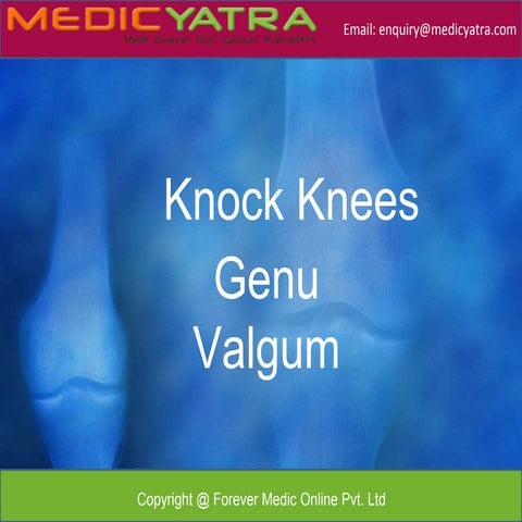 Genu Valgum Treatment & Surgery