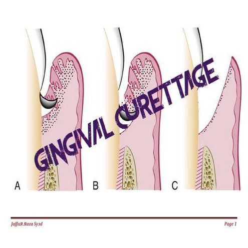 gingival curettage