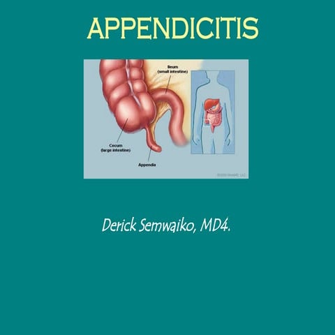 Acute Appendicitis | PPTX