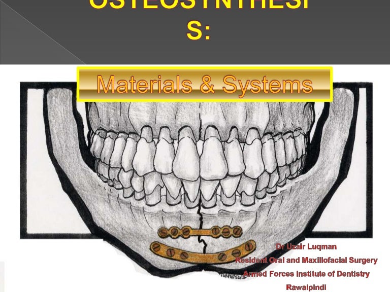 Triangular osteosynthesis orthobullets picture