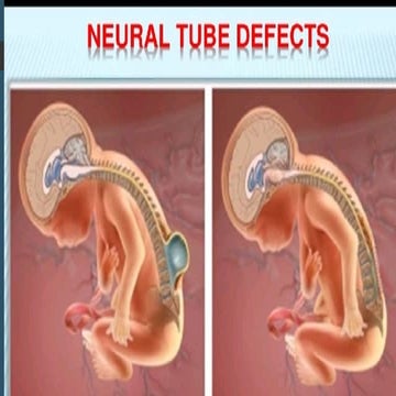 0_NEURAL_TUBE_DEFECTS_PPT-DR.DEEKSHA.pptx
