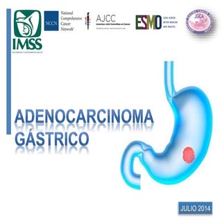 Cáncer Gástrico. Cirugía General