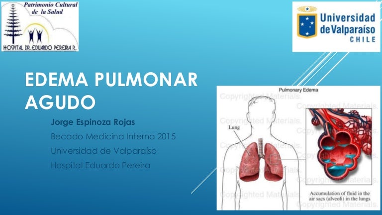 tratamiento para edema pulmonar cronica