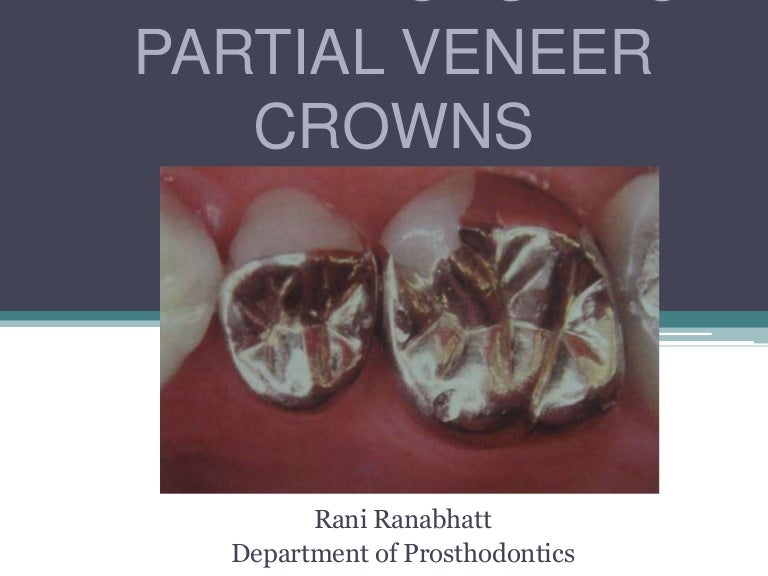Tooth Preparation For Partial Veneer Crwns