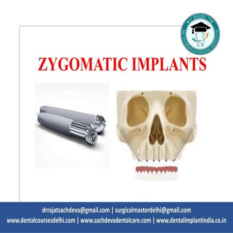  Zygomatic implants