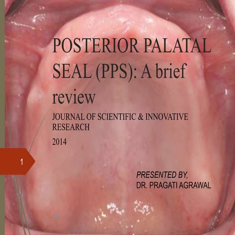 posterior palatal seal