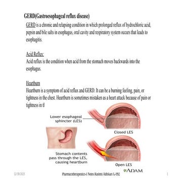 GERD (Gastro Esophageal Reflux Disease).pptx