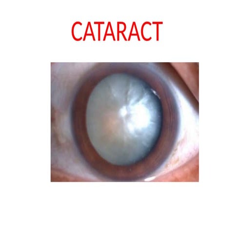 Pediatric cataract | PPTX