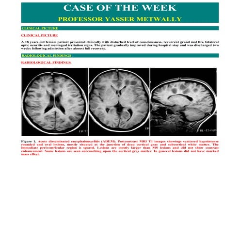 Case record... Acute disseminated encephalomyelitis
