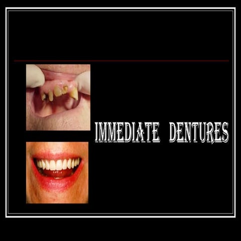 100121562-Immediate-Dentures-ppt-Autosaved.ppt