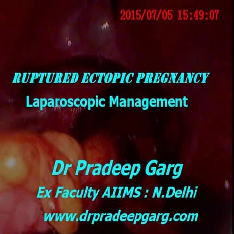 Ruptured Ectopic Pregnancy; Laparoscopic management: Dr Pradeep Garg