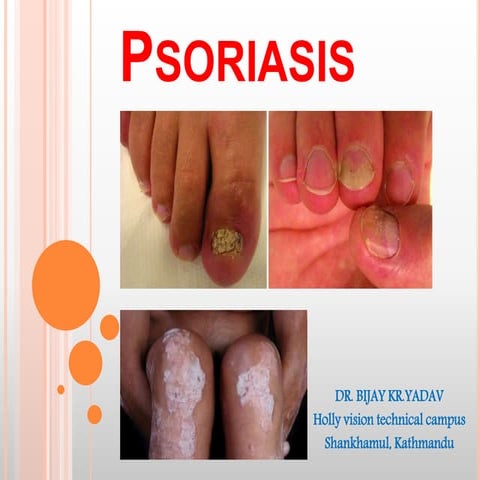 11. Psoriasis