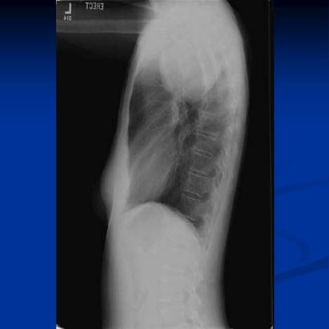 11.21.08 Proctor. Schwannoma.ppt