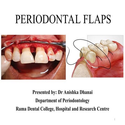 PERIODONTAL FLAP - Classification, Design, Healing