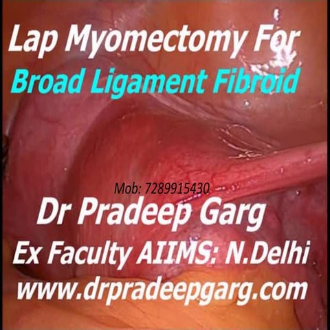 Broad Ligament Myoma ; Laparoscopic Myomectomy : Dr Pradeep Garg
