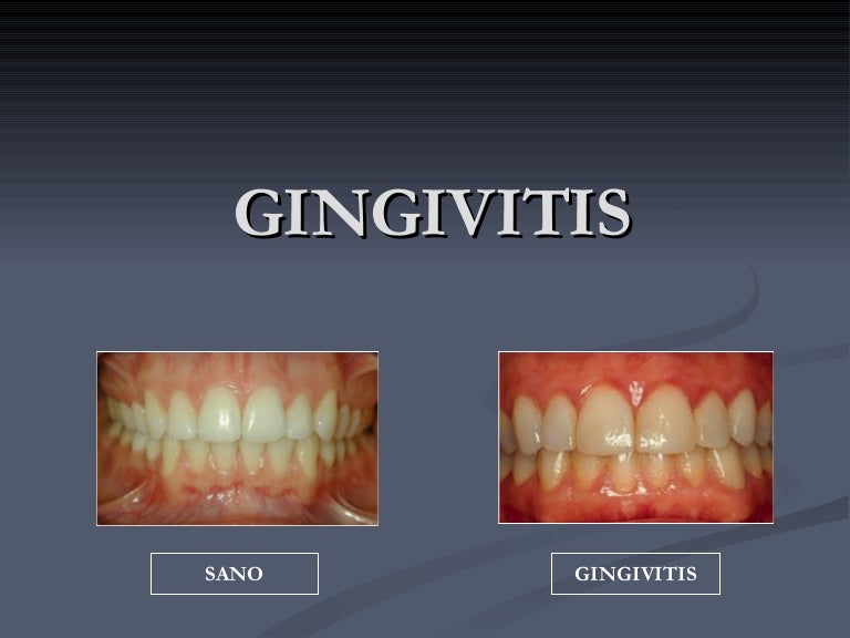 12 Gingivitis