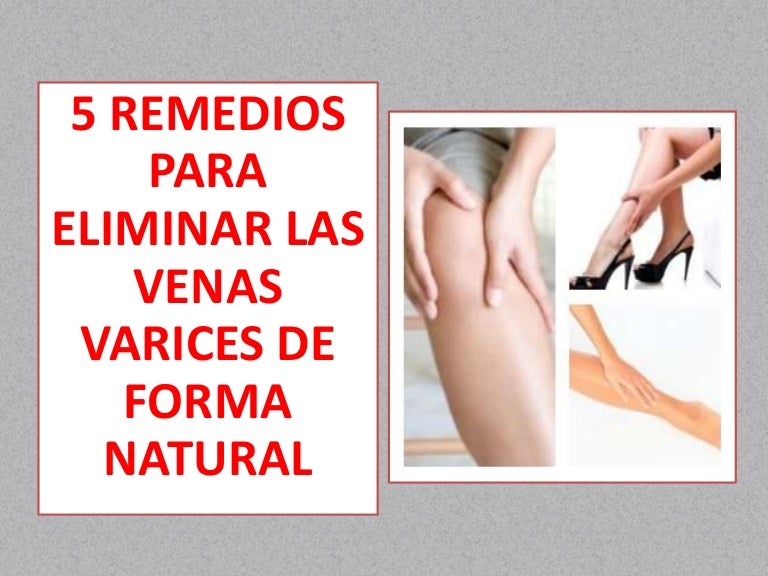 cómo eliminar las venas varicosas