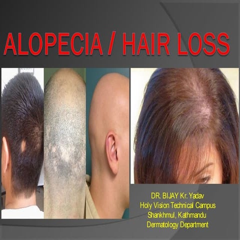 13. Alopecia