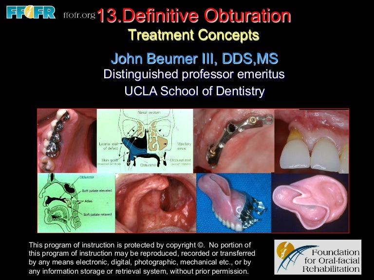 13. definitive obturation treatment concepts