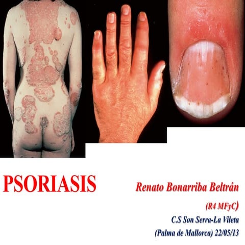 130525 psoriasis pdf
