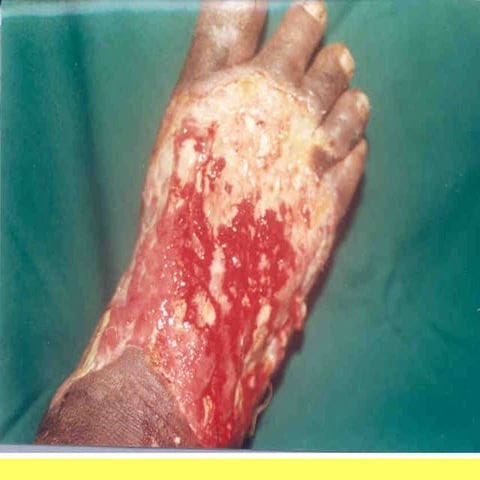 1362466052 tunnda m2-d f ulcer