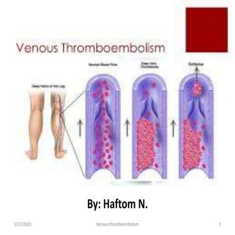 13 Veneou Thromboemblism.pptx