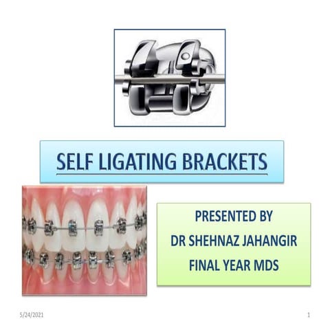 SELF LIGATING BACKETS