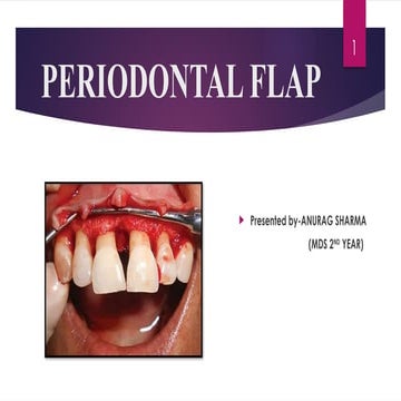 14. Periodontal Flaps in periodontology.pptx