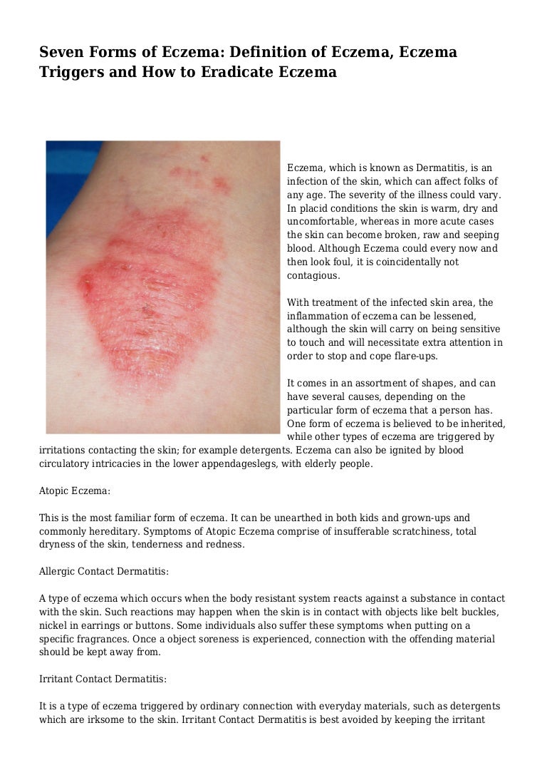 Seven Forms Of Eczema Definition Of Eczema Eczema Triggers And How Seven Forms Of Eczema Definition Of Eczema Eczema Triggers And How