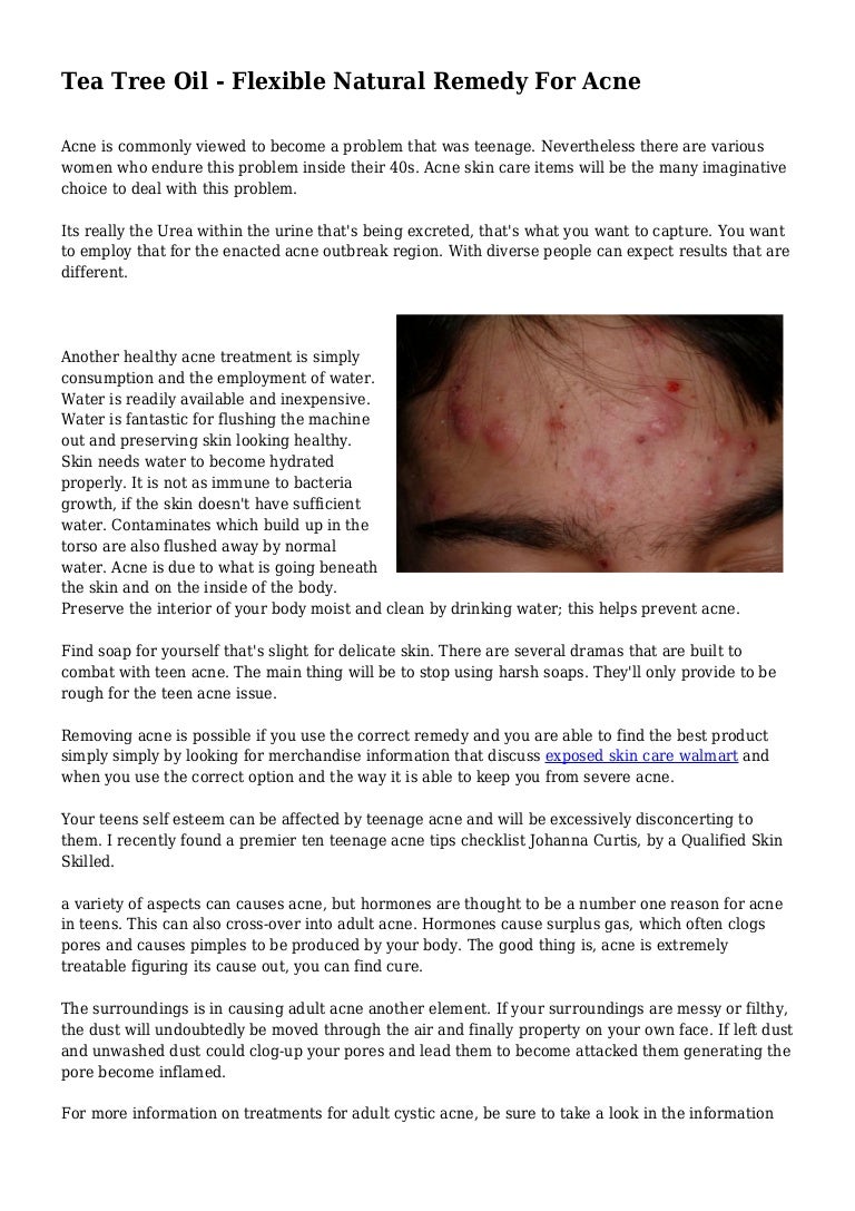 teenage acne natural remedies