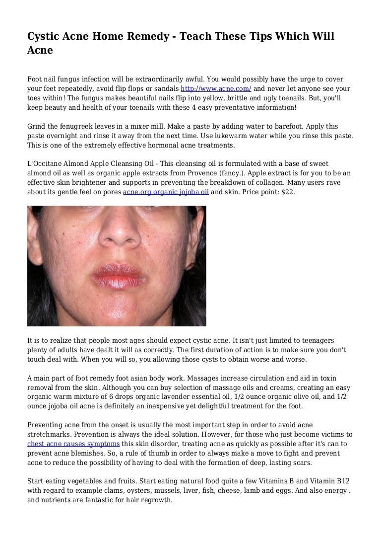 cystic acne treatment home remedy
