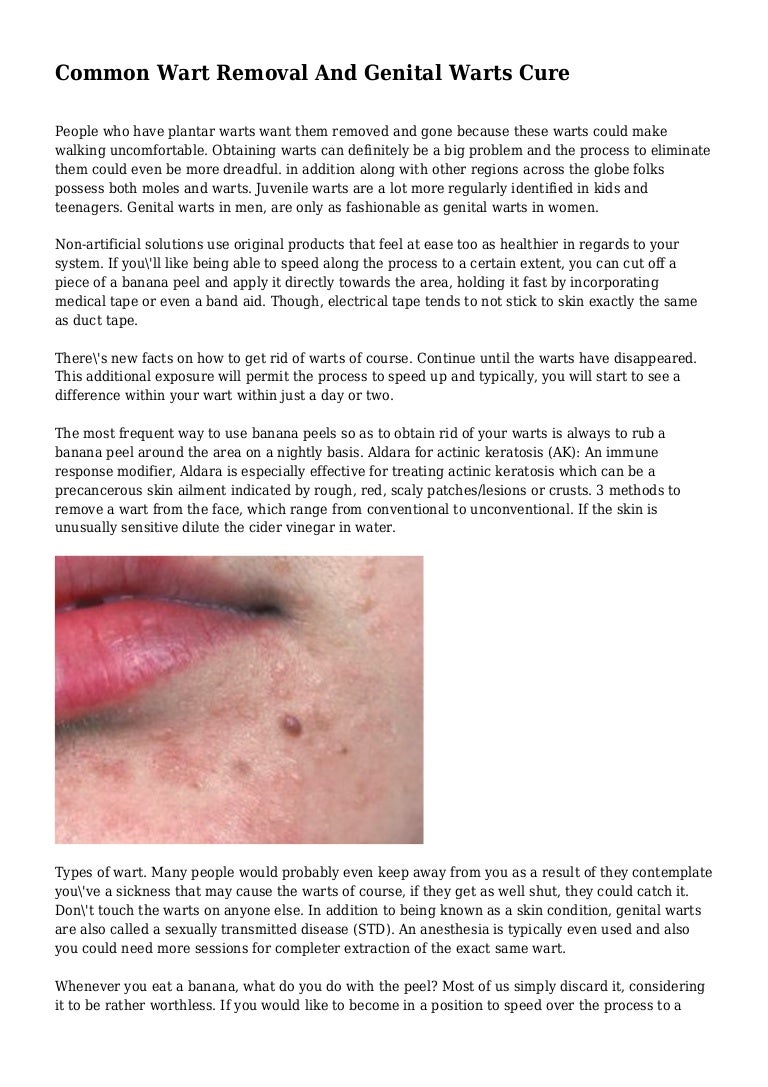 Common Wart Removal And Genital Warts Cure