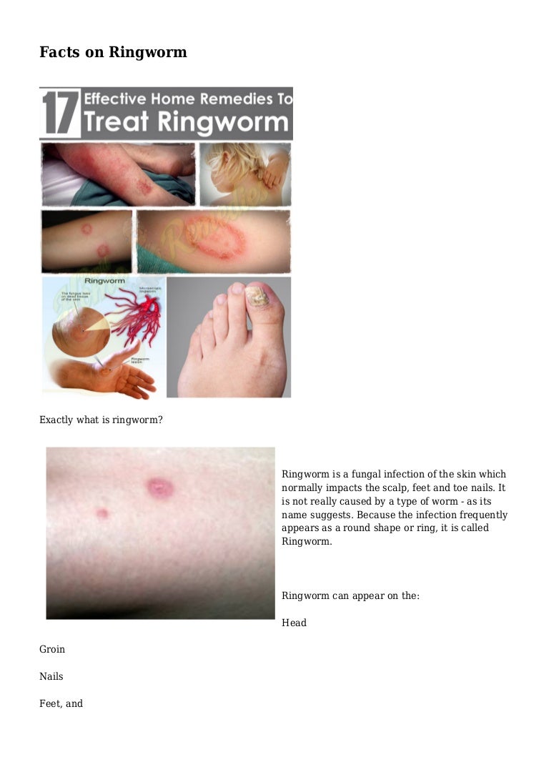 Facts on Ringworm