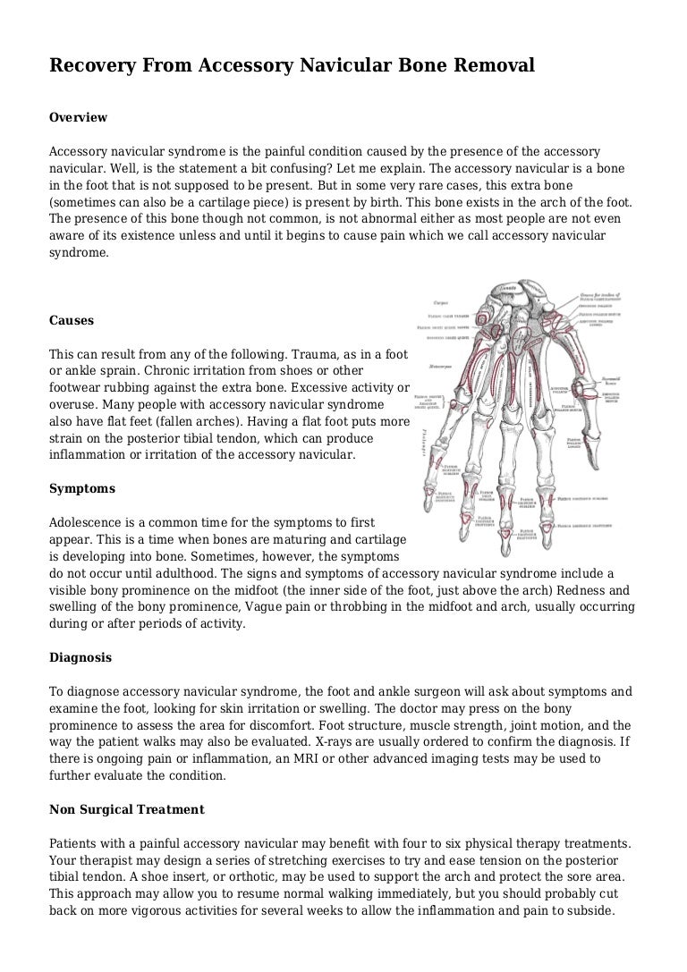 Recovery From Accessory Navicular Bone Removal