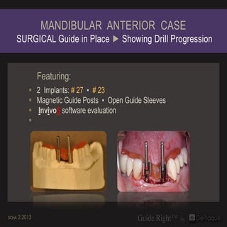 14 mandibular anterior case   open ...
