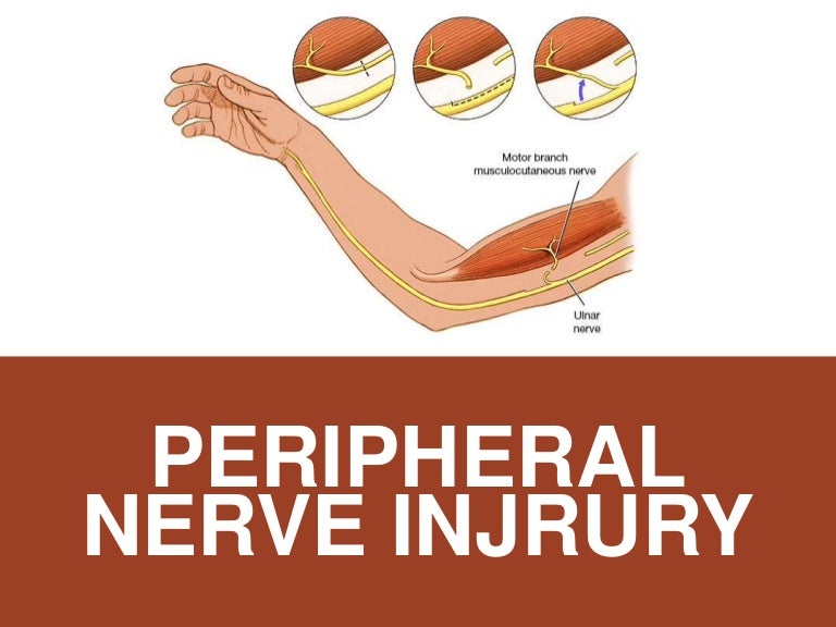 Peripheral Nerve Injuries