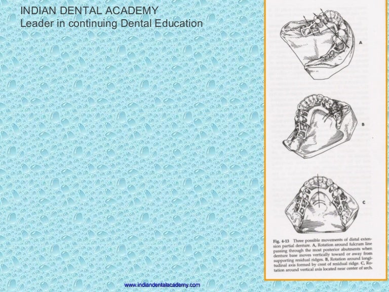 indirect retention /cosmetic dentistry courses