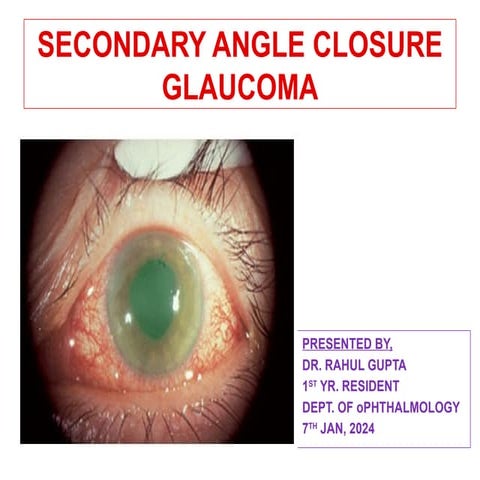 Secondary angle closure glaucoma dr. rahul.pptx