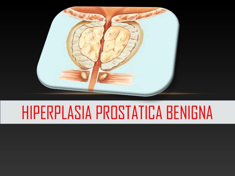 Hiperplasia prostática localizada benigna con síntomas del tracto urinario inferior