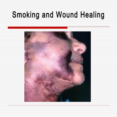 tobacco on open wounds 18. Smoking And Wound Healing