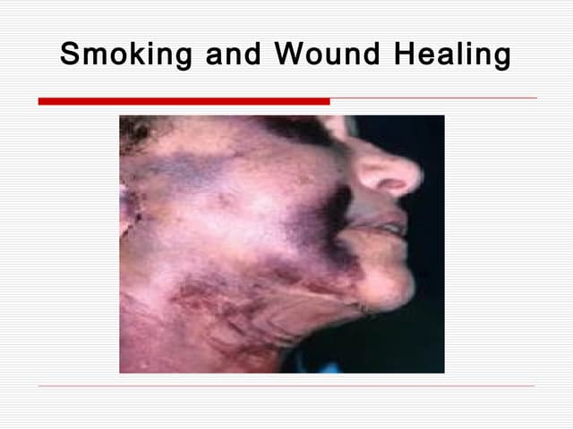 does tobacco heal wounds Smoking Affects Healing Quitting Can Help! Did you know smoking 5 Ways Smoking Can Affect