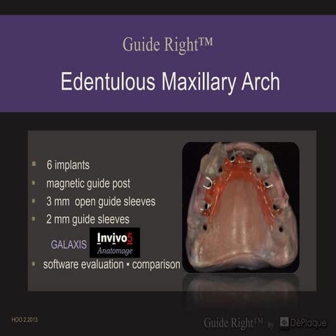18 maxillary edentulous case