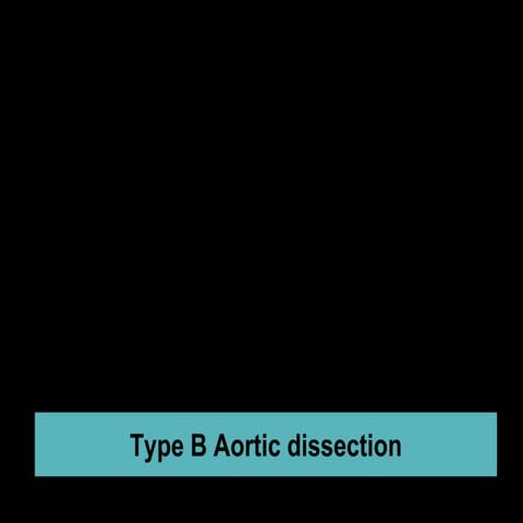 Type B AORTIC DISSECTION