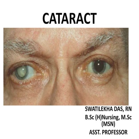 Cataract  - Easy PPT for Nursing Students