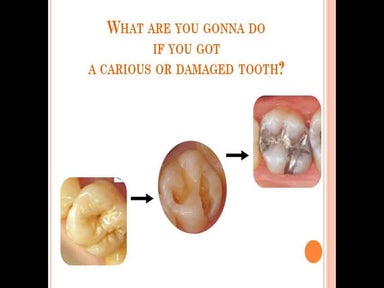  introduction to tooth filling materials dental material