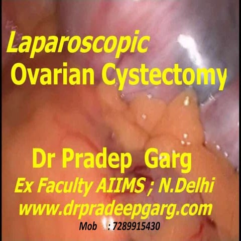 Laparoscopic Ovarian Cystectomy ; Dr Pradeep Garg