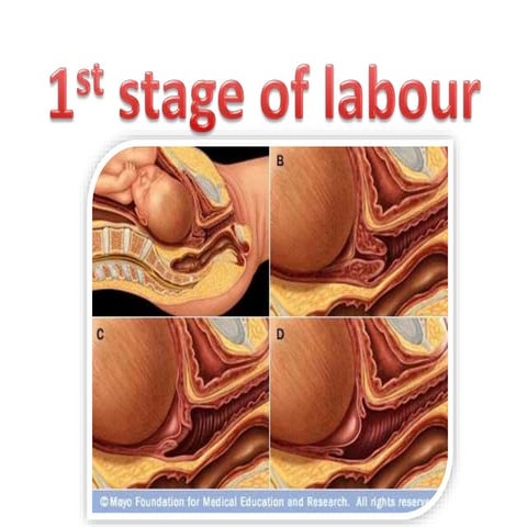 1st stage of labour