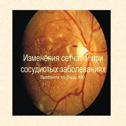 Retropupillary fixation of iris claw iol in phaco complication | PPT