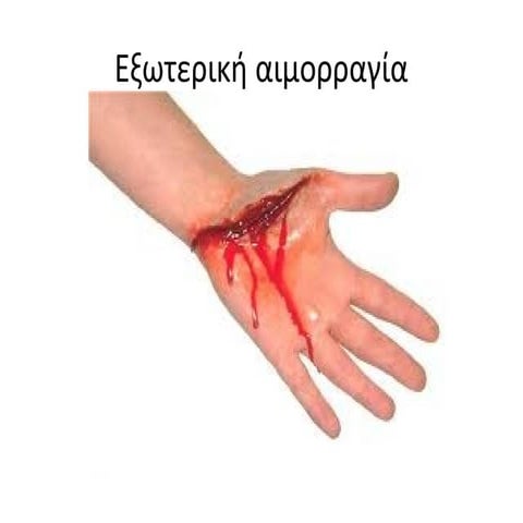 2η συναντηση  αιμοραγια